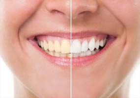 Après un traitement de blanchiment, les dents sont généralement plus blanches de 3 à 4 teintes. Si les dents à traiter sont dans les teintes blanches ou jaunes, le traitement aura un meilleur résultat que si les dents étaient de couleur marron ou grise. Ces 2 teintes sont difficiles à blanchir. De plus, si les dents sont jaunes à cause des médicaments comme des antibiotiques ou d’une maladie, il est plus difficile de les rendre complètement blanches mais il est cependant possible de gagner quelques teintes.
